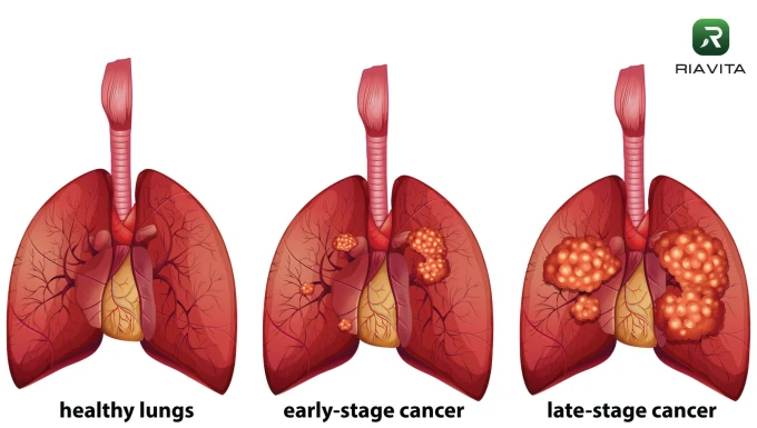 RIAVITA: Ung thư Phổi – Triệu chứng và Dấu hiệu phát hiện sớm